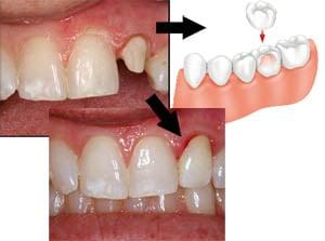 Expert Dental Crown and Bridge