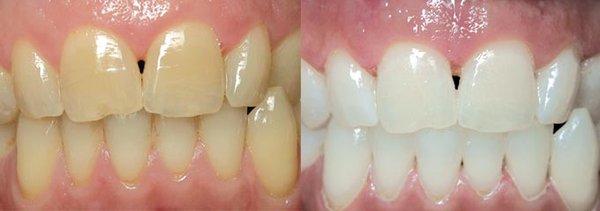 Teeth Whitening Before and After