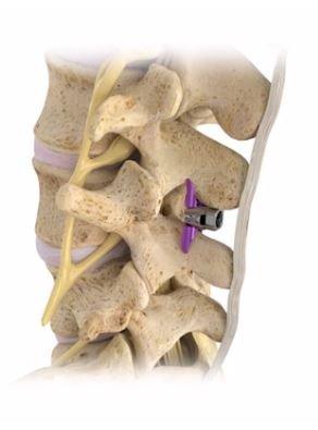 Offering Superion procedure for Spinal Stenosis sufferers!  Minimally invasive!  Dr. Lim is first to perform procedure in Orange County.