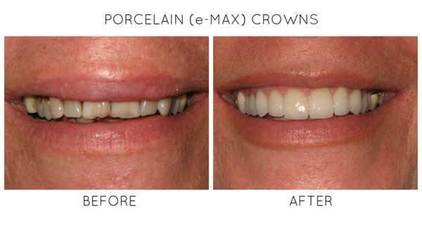 Before and After - Porcelain e-Max Crowns, Metal-Free Crowns, All-Porcelain Crowns, Cosmetic Dentistry, Cosmetic Crown