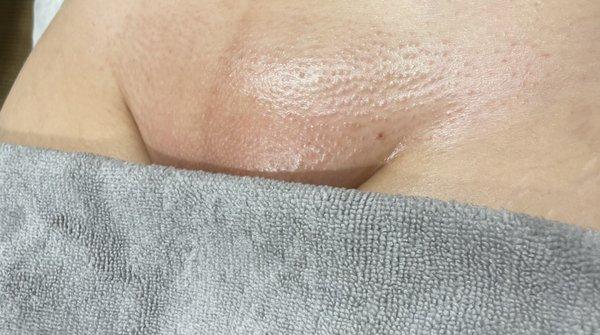 Brazilian Wax after results