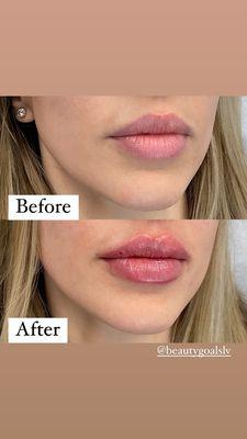 Lip filler