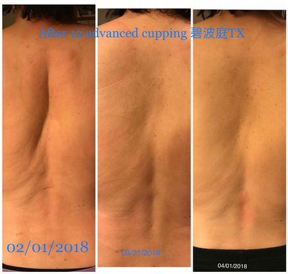 Back lipo reduction after 12 advanced cupping treatments (non surgical)