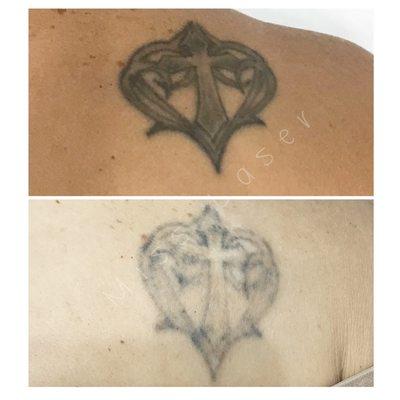 Tattoo removal, work in progress