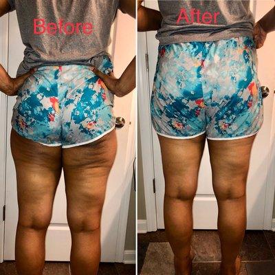 Bye bye Cellulite. This the first session results 28 minutes later. Day 3 results are even better