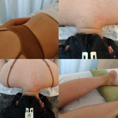 Acupuncture focuses on low right back aches and muscle tension on the trapeze.