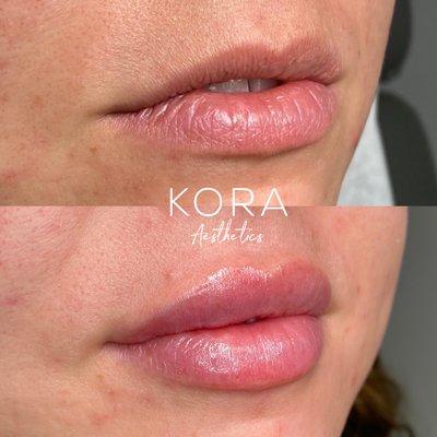 We use Restylane, Versa, and RHA lip fillers.