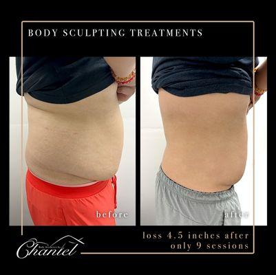 Ultrasound cavitation along with radio frequency and laser lipo- Body Sculpting package.