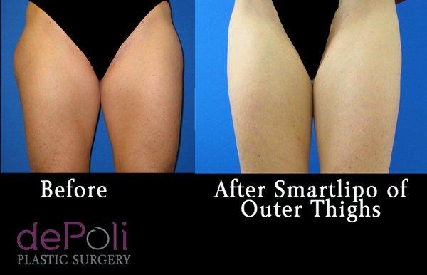 Smartlipo of bilateral outer thighs