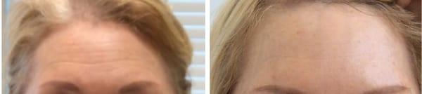 Botox - Before/After