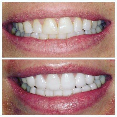 Upper and lower veneers to make teeth whiter, nicer shape and straight