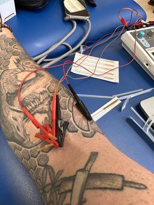 Dry needling coupled with stim for lateral epicondylitis