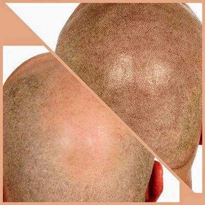 SMP-scalp micropigmentation for hair loss