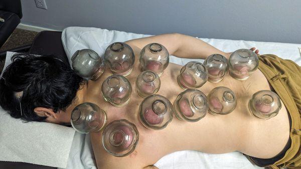 Acupuncture and cupping at the same time