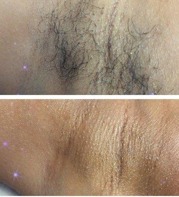 Underarm hair removal (wax)