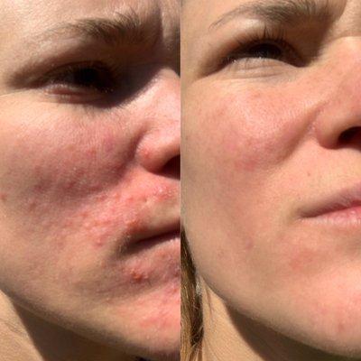 Rosacea treatment before/ after.