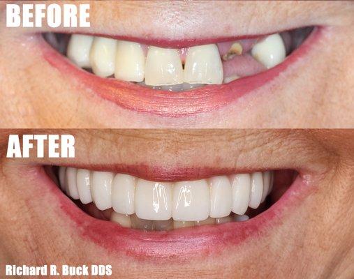 Full Upper Implant Denture with Zirconia Done By Richard Buck DDS