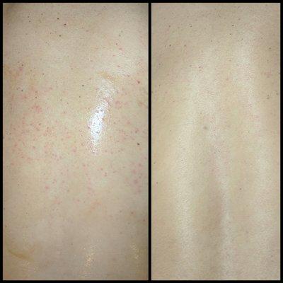 This is my before and after picture when I received my Enzyme Back Facial from Annalee. Thank You