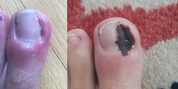 Toenail Infections - Overnight difference with herb