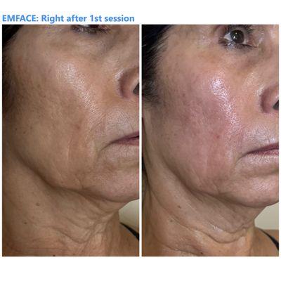 Result from the first session of EMFACE face lift treatment (right after the treatment)