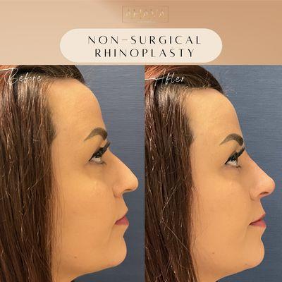 Non-surgical rhinoplasty