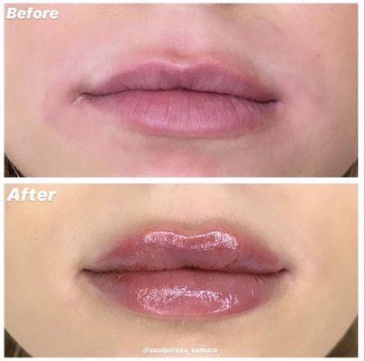 Lip filler, before and after