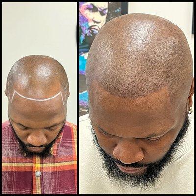 Before & After Scalp Micropigmentation.