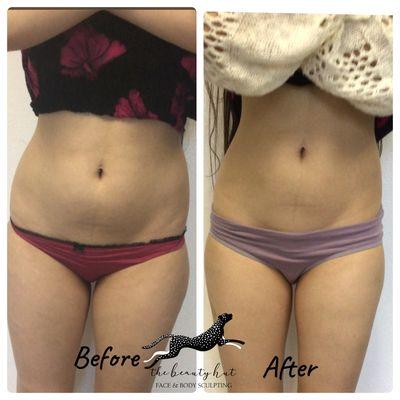 Before and after amazing results after a series of Coolsculpting  treatments here at The Beauty Hut