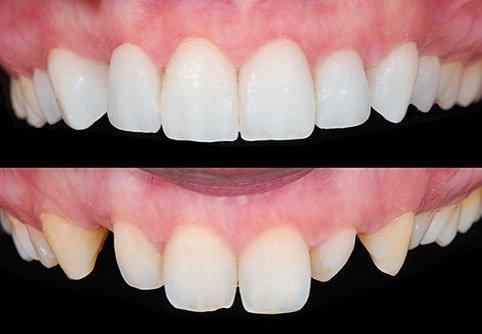 Veneers can correct spacing, color and crowding issues!