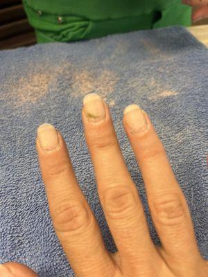 Nail fungus.