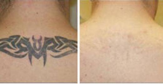 Laser Tattoo Removal