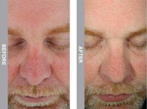 HydraFacial Before and After