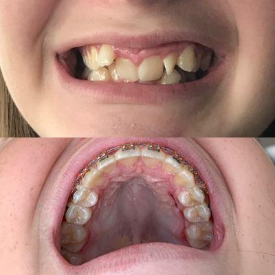 Dr Jergensen was able to achieve amazing results without pulling healthy teeth like other orthodontists had recommended