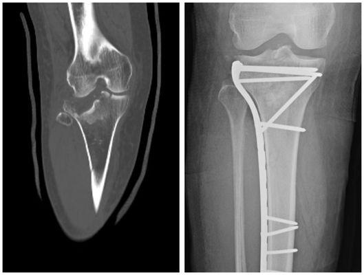 Tibia Plateau Open Reduction & Internal Fixation (ORIF) Before & After