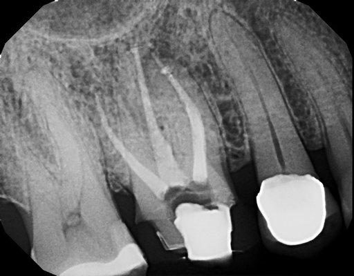 My root canal after skilled repair by experienced DDS.