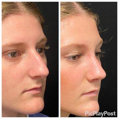 Rhinoplasty before and after