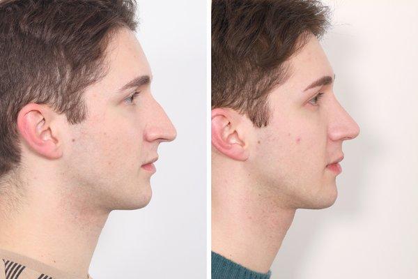 6 months after male rhinoplasty by Dr. Ben Paul