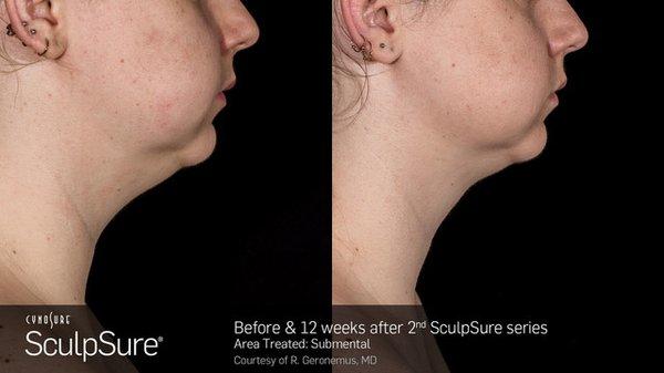 Double Chin Reduction with SculpSure Submental