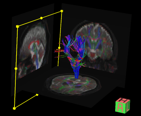 DTI MRI for head trauma