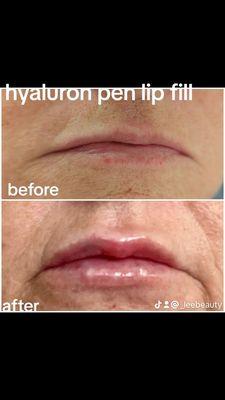 Hyaluronic acid injected needlelessly  to plump the lips