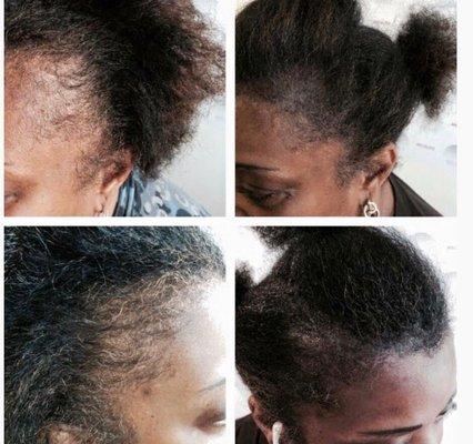 Thinning edges? Hairline time creates density in just 1 day!