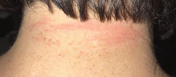 The back of my neck was red and hurt hours after she used the clippers on my neck. It stung when she did it too.