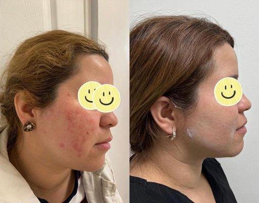 Rosacea treatment