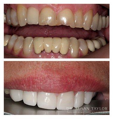 Before & After: Custom Porcelain Veneers and Crowns. Actual patient of Dr Susan Taylor