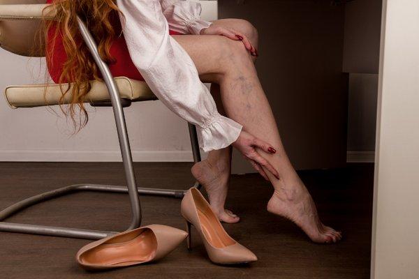 Varicose veins can cause leg cramps