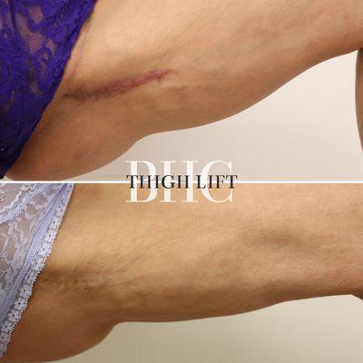 Thigh Lift Scar