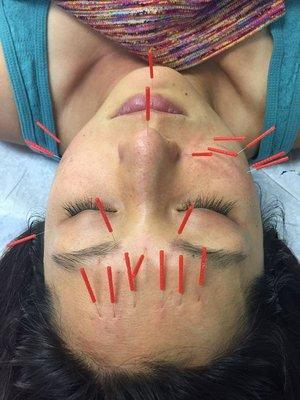 Acupuncture for Facial Rejuvenation