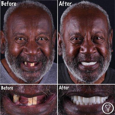 Full mouth reconstruction with dental implants!