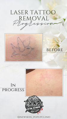 In Progress: 2 Sessions spaced 4 months apart for laser tattoo removal