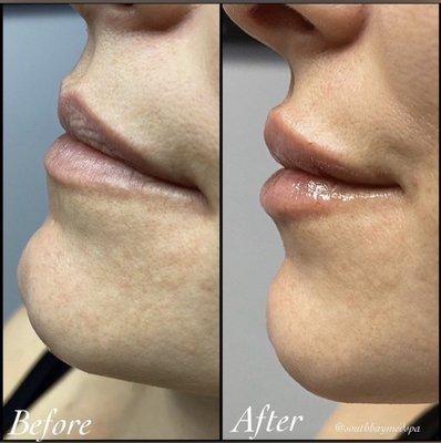 Our beautiful patient did 1 syringe of Restylane to enhance her lips.